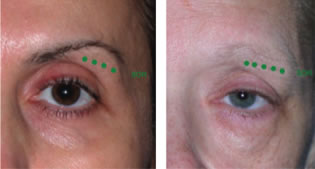 Sagging Brow Correction at PERFECT FACE